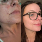MindBodySkin La Formula 1 para combatir el ACNE hormonal - AURÈNE