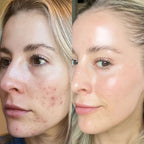 MindBodySkin La Formula 1 para combatir el ACNE hormonal - AURÈNE