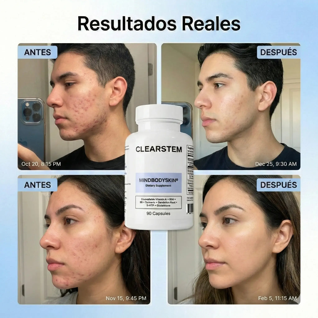 MindBodySkin La Formula 1 para combatir el ACNE hormonal - AURÈNE