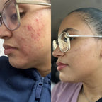MindBodySkin La Formula 1 para combatir el ACNE hormonal - AURÈNE