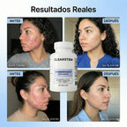 MindBodySkin La Formula 1 para combatir el ACNE hormonal - AURÈNE