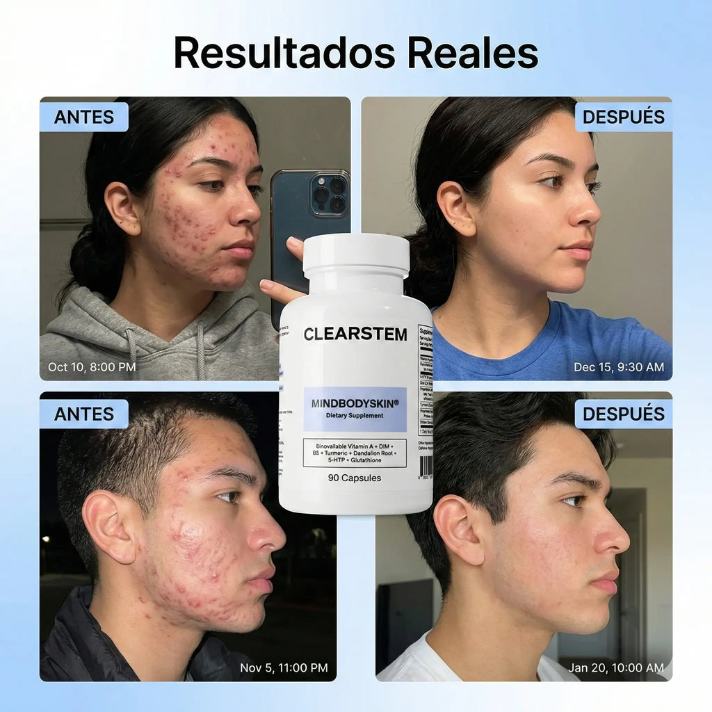MindBodySkin La Formula 1 para combatir el ACNE hormonal - AURÈNE