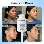 MindBodySkin La Formula 1 para combatir el ACNE hormonal - AURÈNE