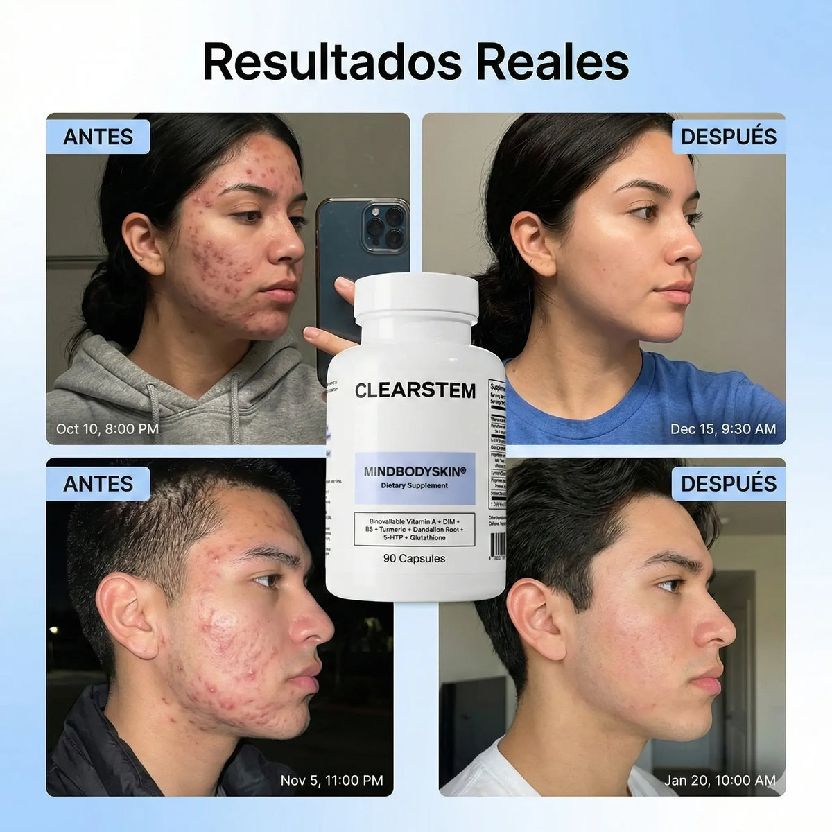 MindBodySkin La Formula 1 para combatir el ACNE hormonal - AURÈNE